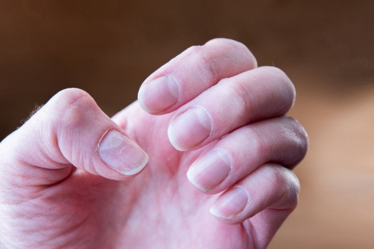 Изменения на ногтях могут предупреждать о диабете